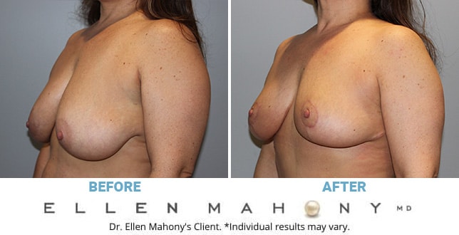 Before and After Image: Case #10601 - left-front-oblique
