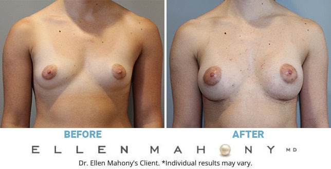 Before and After Image: Case #10188 - front