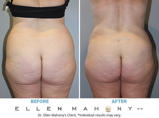 Before and After Image: Case #10208 - back