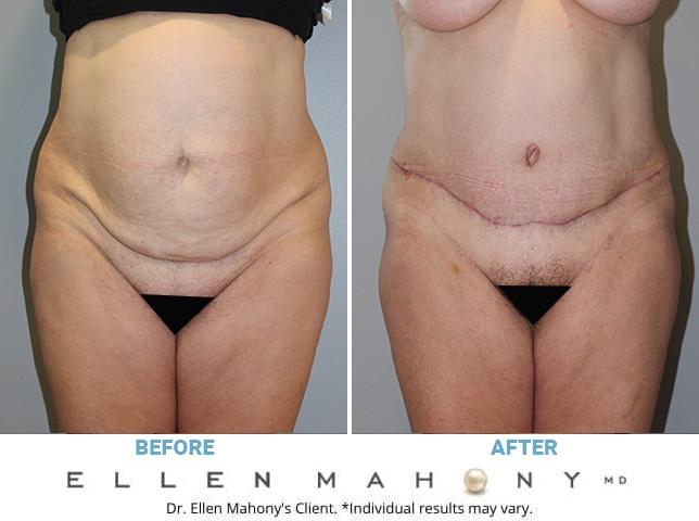 Before and After Image: Case #10208 - front