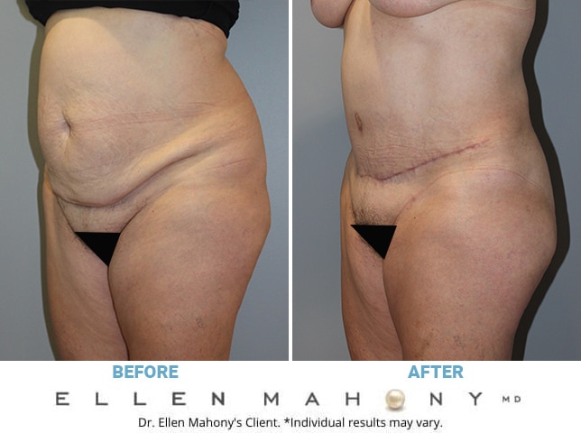 Before and After Image: Case #10208 - left-front-oblique