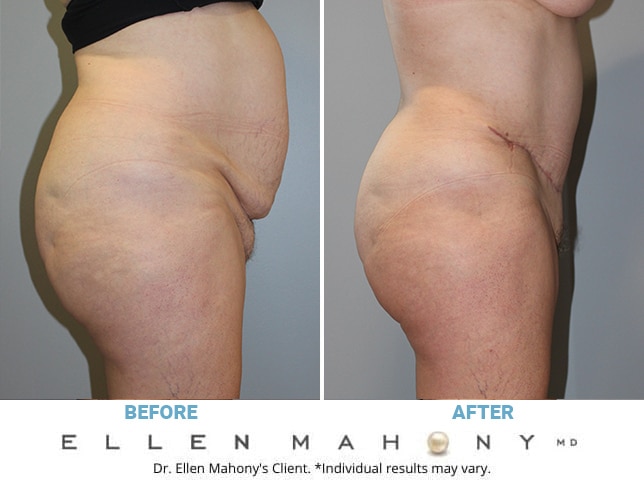 Before and After Image: Case #10208 - right-side