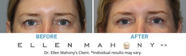 Before and After Image: Case #3228 - front