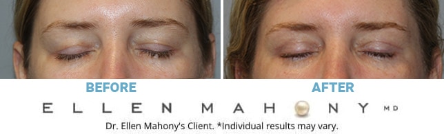 Before and After Image: Case #3228 - front