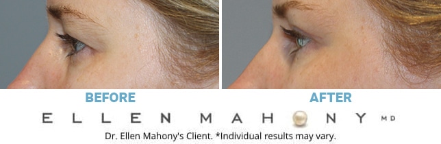 Before and After Image: Case #3228 - left-side