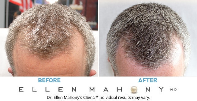 Before and After Image: Case #10024 - front