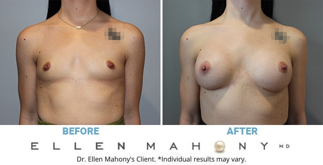Before and After Image: Case #10923 - front