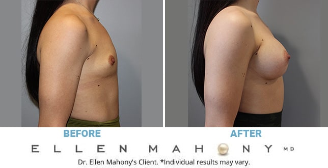 Before and After Image: Case #10923 - right-side