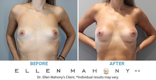 Before and After Image: Case #11353 - front