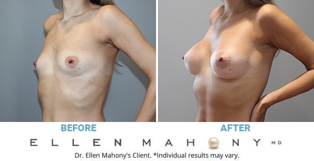 Before and After Image: Case #11353 - left-front-oblique