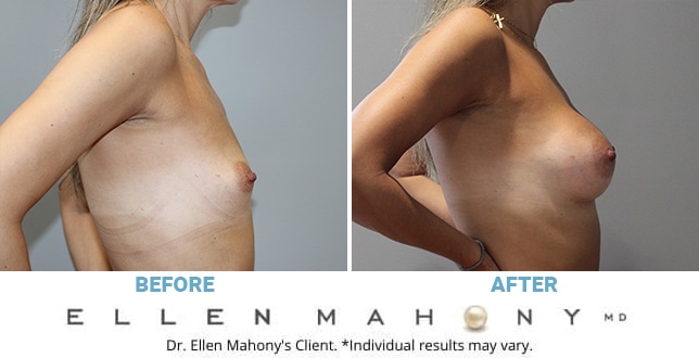 Before and After Image: Case #11353 - right-side