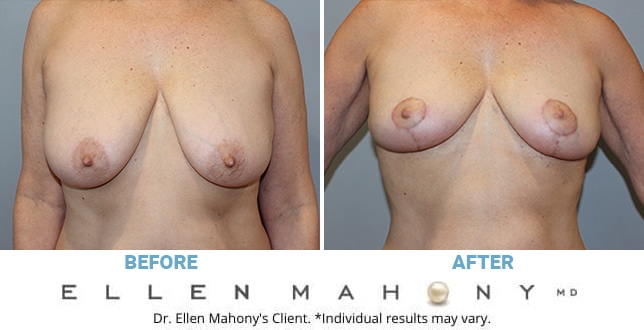 Before and After Image: Case #11143 - front