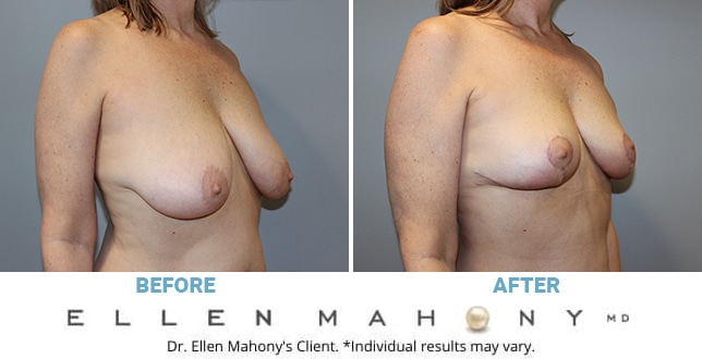 Before and After Image: Case #11143 - right-front-oblique