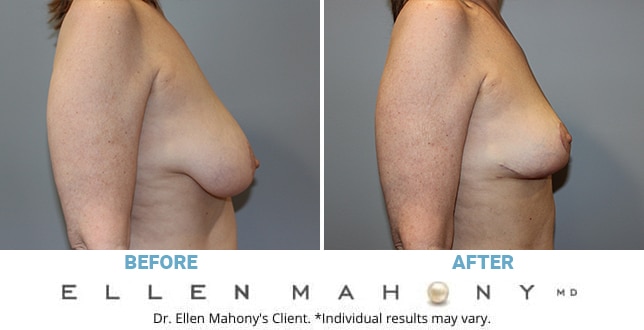 Before and After Image: Case #11143 - right-side