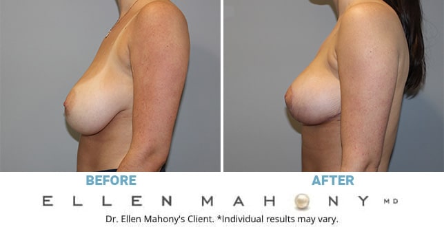 Before and After Image: Case #11219 - left-side