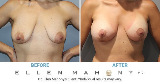 Before and After Image: Case #11356 - front
