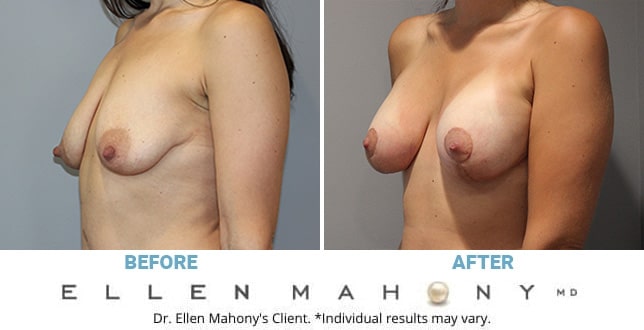 Before and After Image: Case #11356 - left-front-oblique