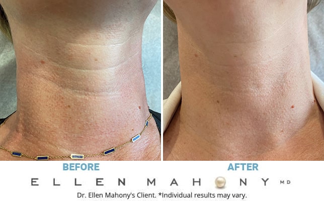 Before and After Image: Case #3228 - front