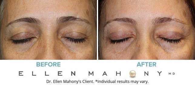 Before and After Image: Case #9922 - front