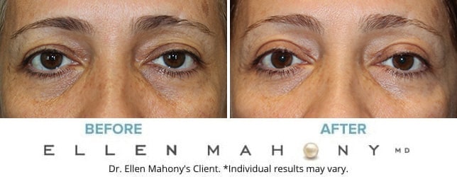 Before and After Image: Case #9922 - front