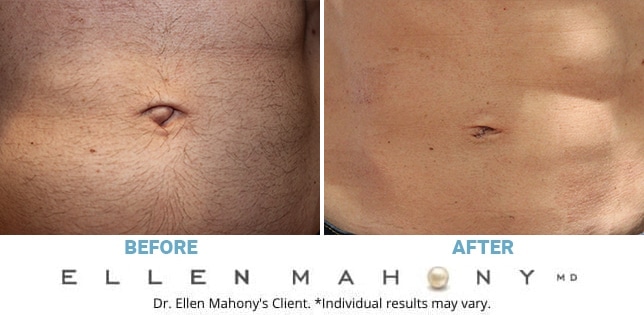 Before and After Image: Case #12107 - front