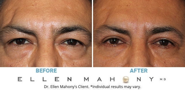 Before and After Image: Case #11774 - front