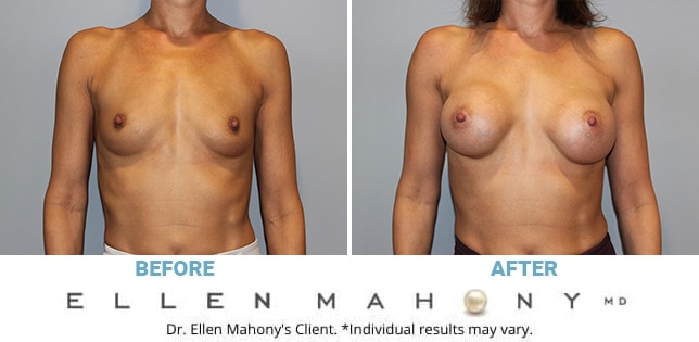 Before and After Image: Case #11777 - front