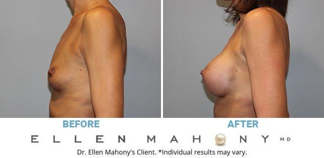 Before and After Image: Case #11777 - left-side