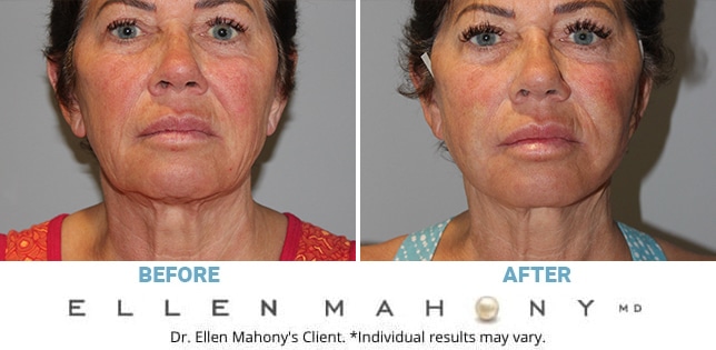 Before and After Image: Case #12045 - front