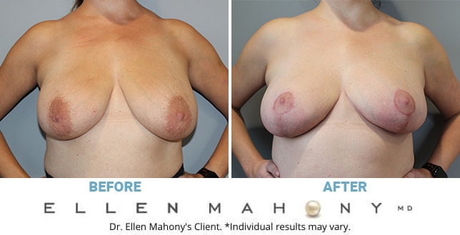 Before and After Image: Case #11756 - front