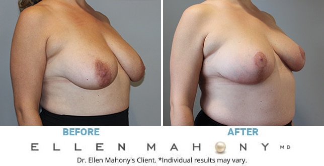 Before and After Image: Case #11756 - right-front-oblique