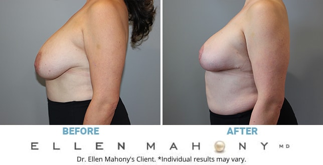 Before and After Image: Case #11756 - left-side