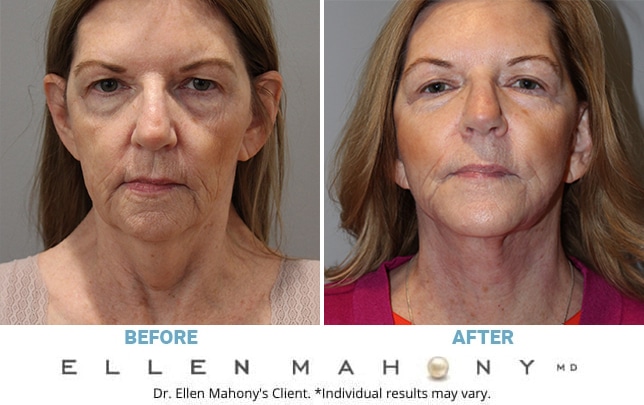 Before and After Image: Case #10645 - front