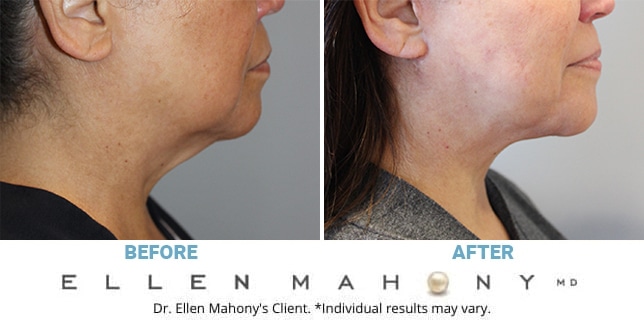 Before and After Image: Case #10068 - right-side