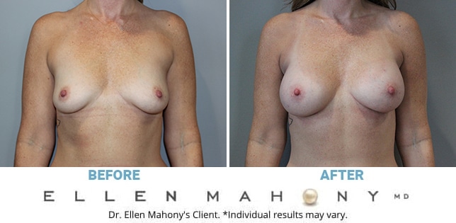 Before and After Image: Case #11913 - front