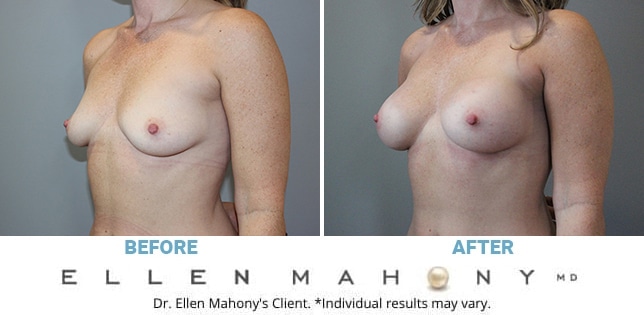 Before and After Image: Case #11913 - left-front-oblique