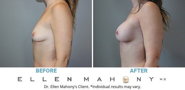 Before and After Image: Case #11913 - left-side