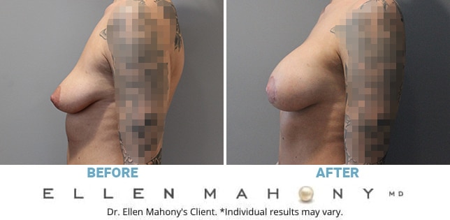 Before and After Image: Case #11730 - left-side