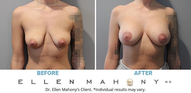 Before and After Image: Case #11730 - front