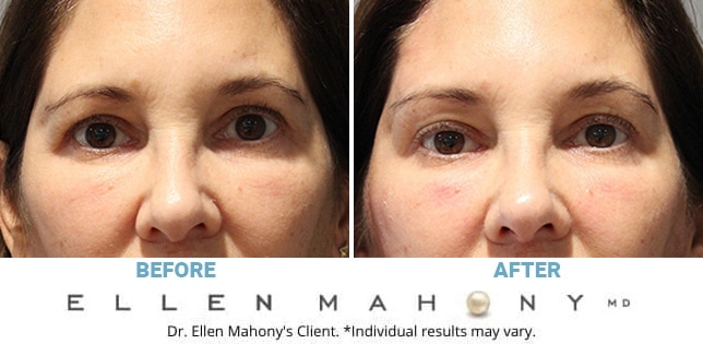 Before and After Image: Case #11186 - front