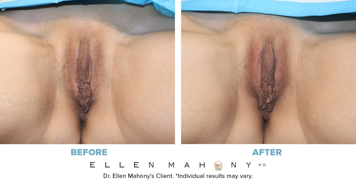Before and After Image: Case #7018 - front