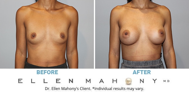 Before and After Image: Case #11655 - front