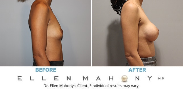 Before and After Image: Case #11655 - right-side