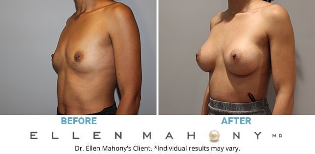 Before and After Image: Case #11655 - left-front-oblique