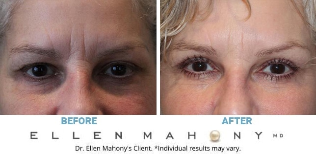 Before and After Image: Case #10924 - front
