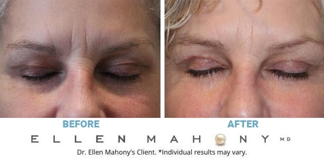 Before and After Image: Case #10924 - front
