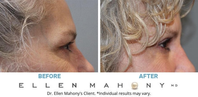 Before and After Image: Case #10924 - right-side