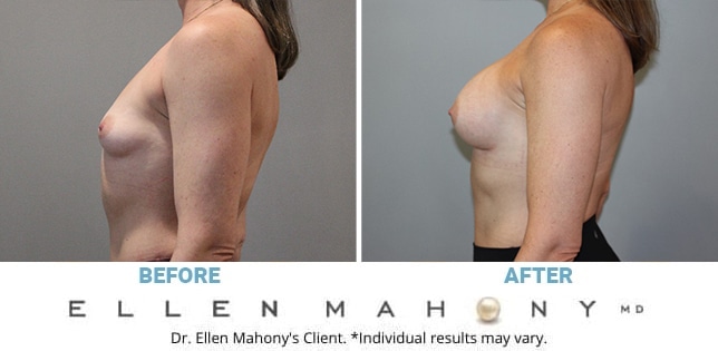 Before and After Image: Case #11730 - left-side