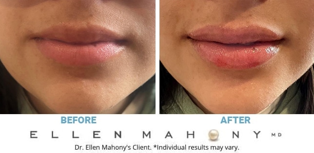 Before and After Image: Case #12210 - front