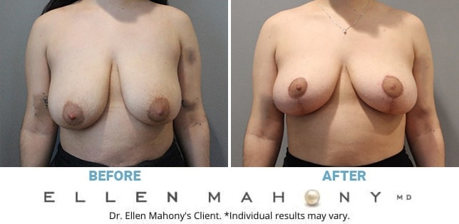 Before and After Image: Case #12366 - front